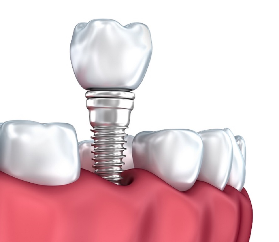 کلینیک دندانپزشکی مهر - دریافت پروتز ثابت متکی بر ایمپلنت1.jpg